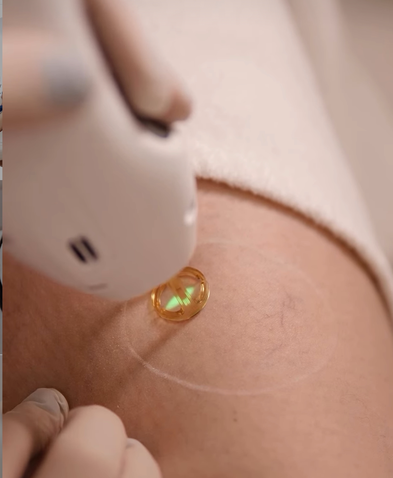 laser-treatments-2